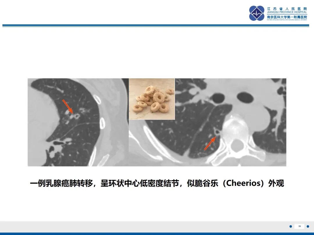 影像PPT - 【PPT】​罕见的肺内脑膜瘤结节—肺转移性脑膜瘤-40