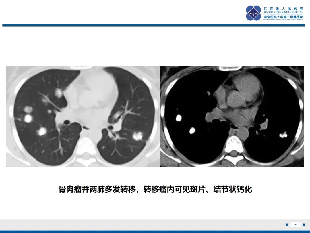 影像PPT - 【PPT】​罕见的肺内脑膜瘤结节—肺转移性脑膜瘤-41