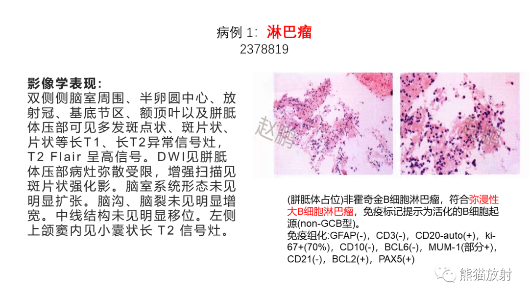 影像PPT - 【PPT】胼胝体 弥漫性大B细胞淋巴瘤 VS 胶质母细胞瘤-16