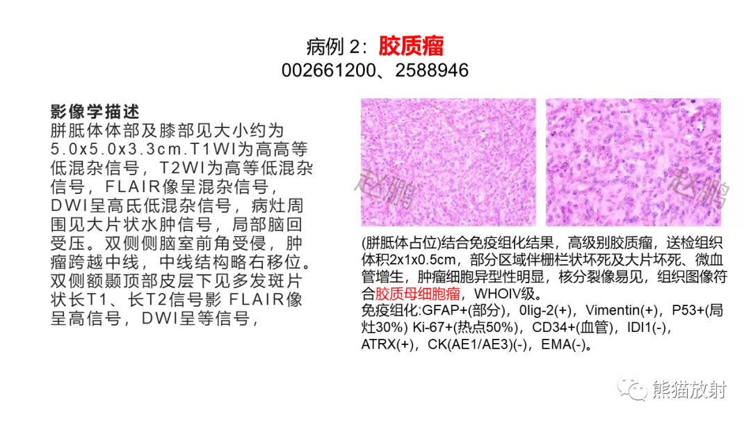 影像PPT - 【PPT】胼胝体 弥漫性大B细胞淋巴瘤 VS 胶质母细胞瘤-17