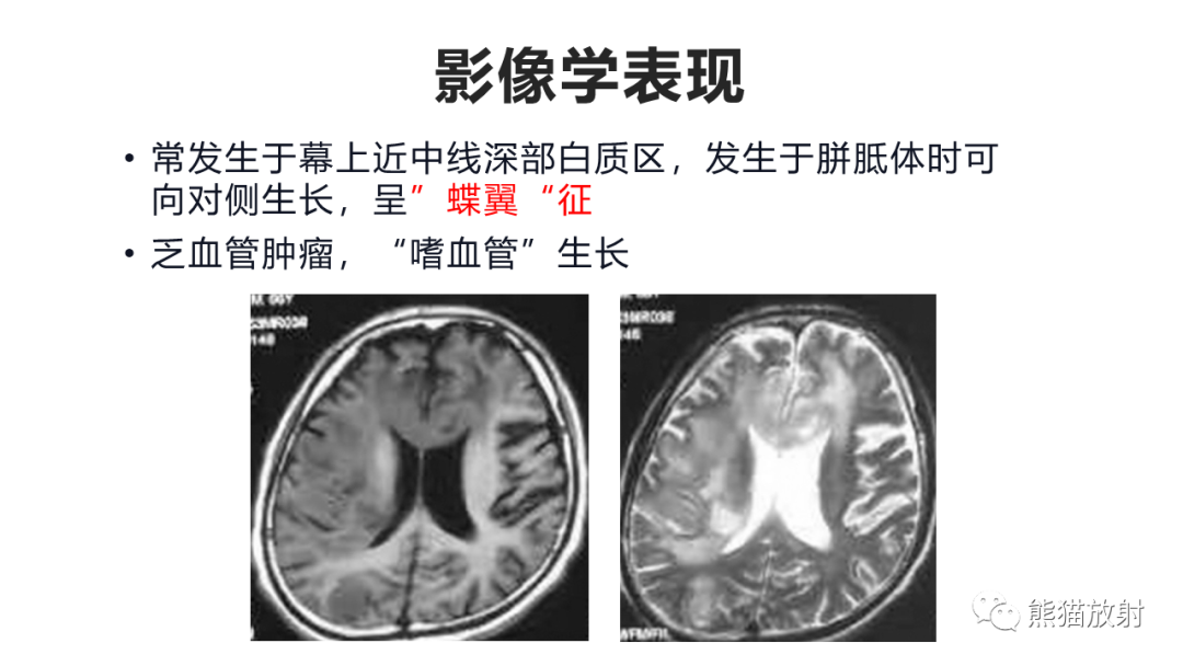影像PPT - 【PPT】胼胝体 弥漫性大B细胞淋巴瘤 VS 胶质母细胞瘤-21