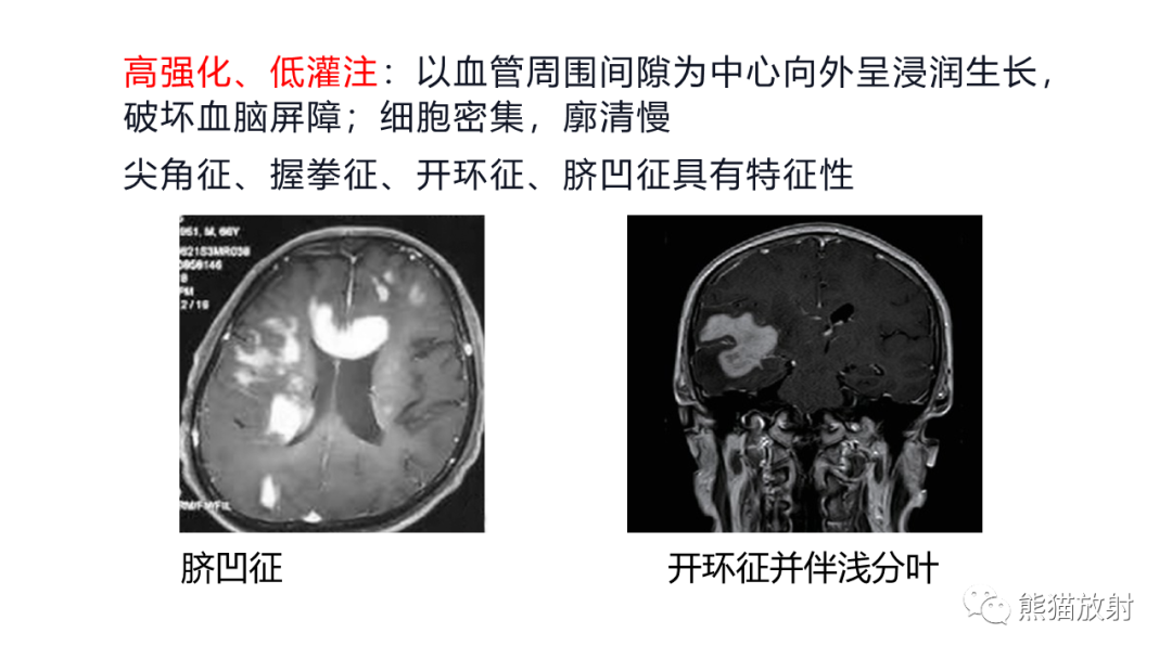 影像PPT - 【PPT】胼胝体 弥漫性大B细胞淋巴瘤 VS 胶质母细胞瘤-23
