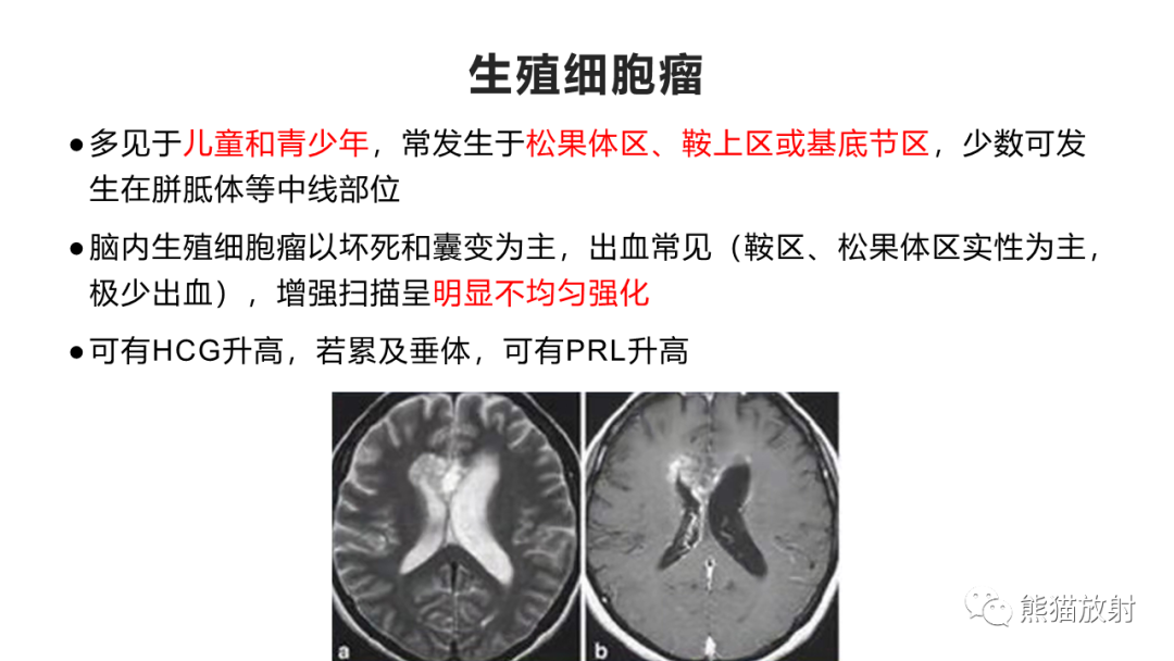 影像PPT - 【PPT】胼胝体 弥漫性大B细胞淋巴瘤 VS 胶质母细胞瘤-30
