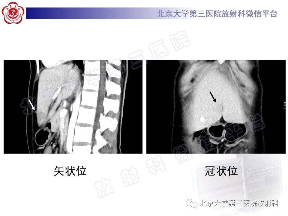 影像PPT - 【PPT】镰状韧带旁肝假性病灶-4