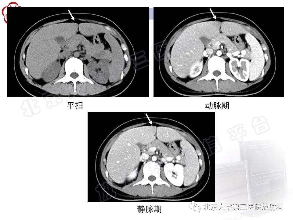 影像PPT - 【PPT】镰状韧带旁肝假性病灶-3