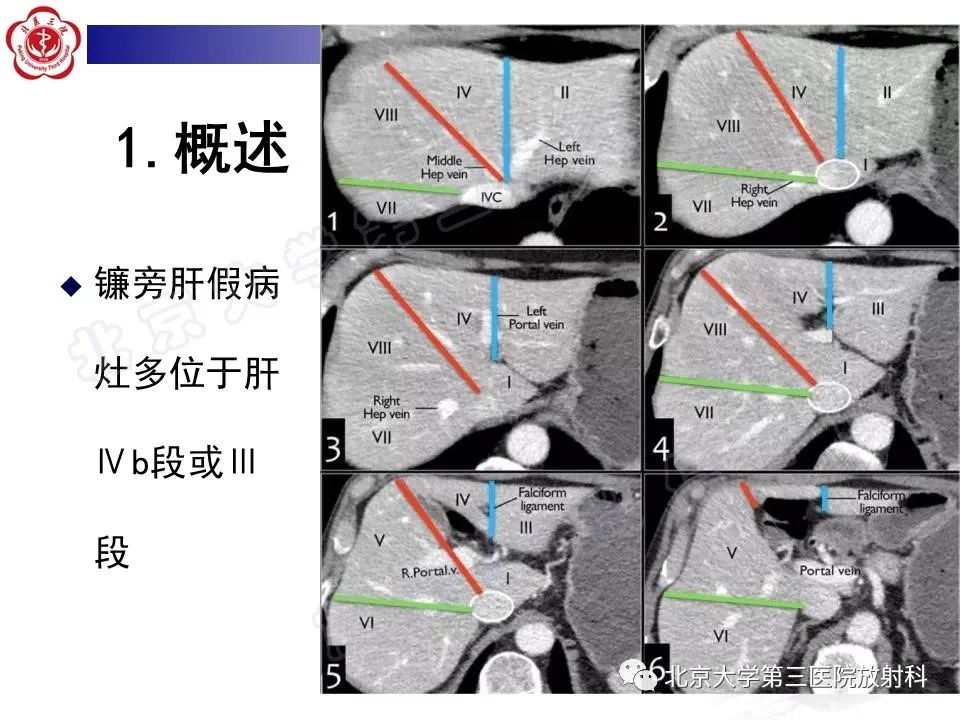 影像PPT - 【PPT】镰状韧带旁肝假性病灶-12
