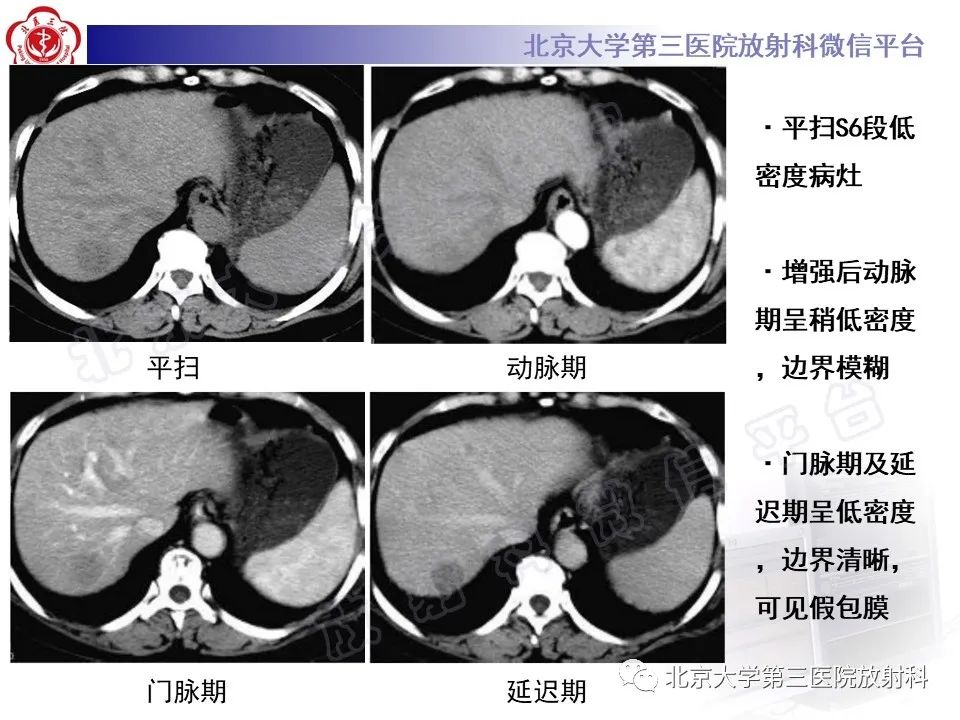 影像PPT - 【PPT】镰状韧带旁肝假性病灶-29