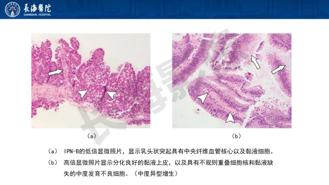 影像PPT - 【PPT】罕见胆道腔内肿瘤的影像学表现-6