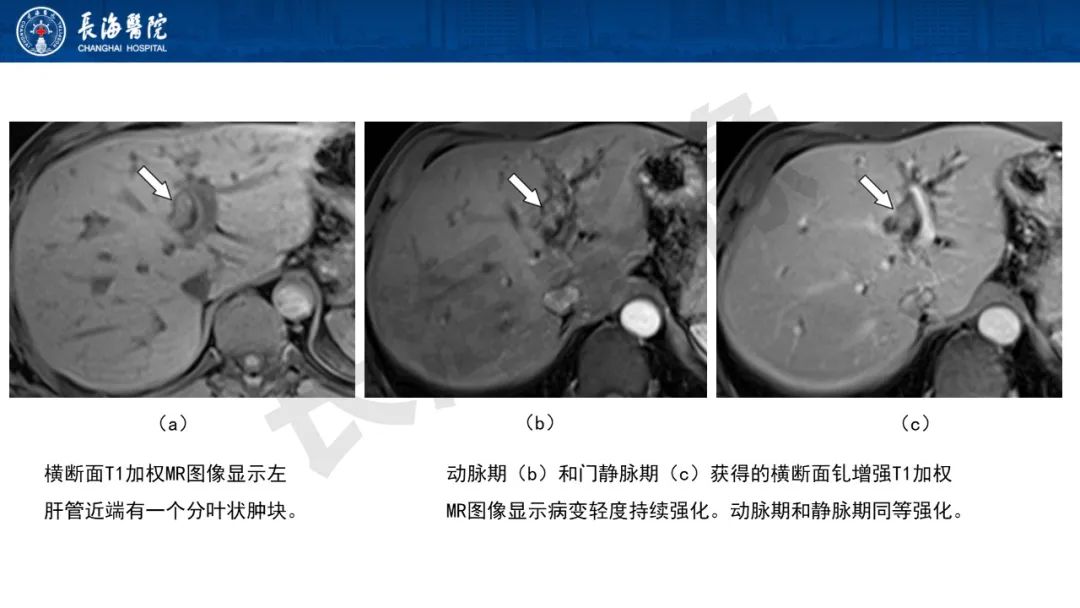 影像PPT - 【PPT】罕见胆道腔内肿瘤的影像学表现-11