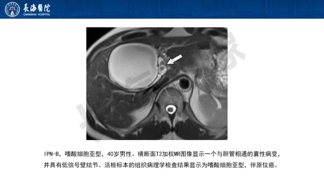 影像PPT - 【PPT】罕见胆道腔内肿瘤的影像学表现-13