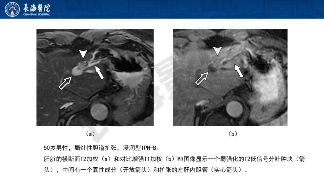 影像PPT - 【PPT】罕见胆道腔内肿瘤的影像学表现-15