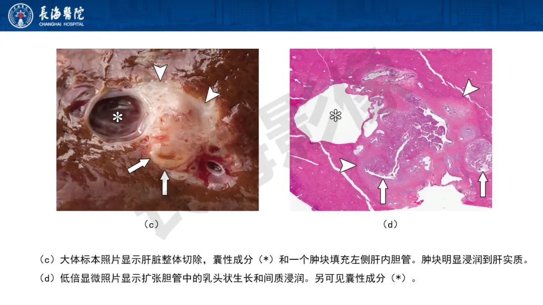 影像PPT - 【PPT】罕见胆道腔内肿瘤的影像学表现-16