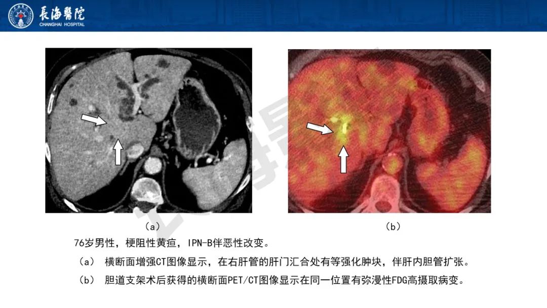 影像PPT - 【PPT】罕见胆道腔内肿瘤的影像学表现-18
