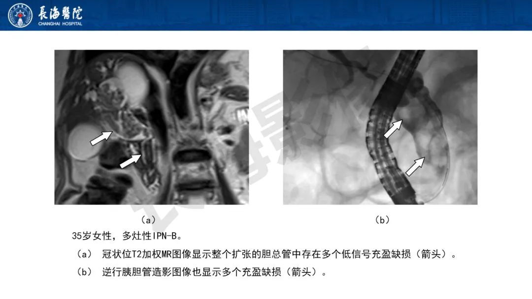 影像PPT - 【PPT】罕见胆道腔内肿瘤的影像学表现-19