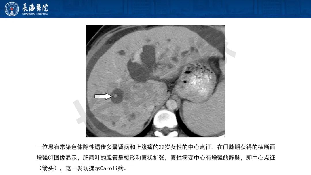 影像PPT - 【PPT】罕见胆道腔内肿瘤的影像学表现-22