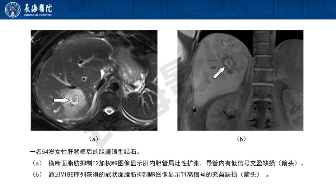 影像PPT - 【PPT】罕见胆道腔内肿瘤的影像学表现-23