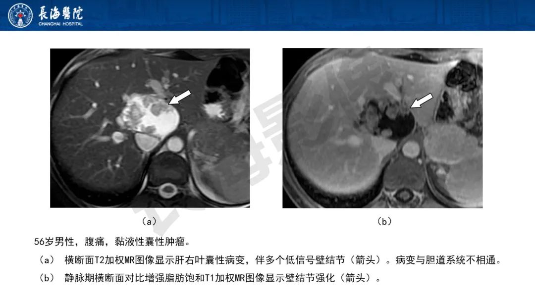 影像PPT - 【PPT】罕见胆道腔内肿瘤的影像学表现-27