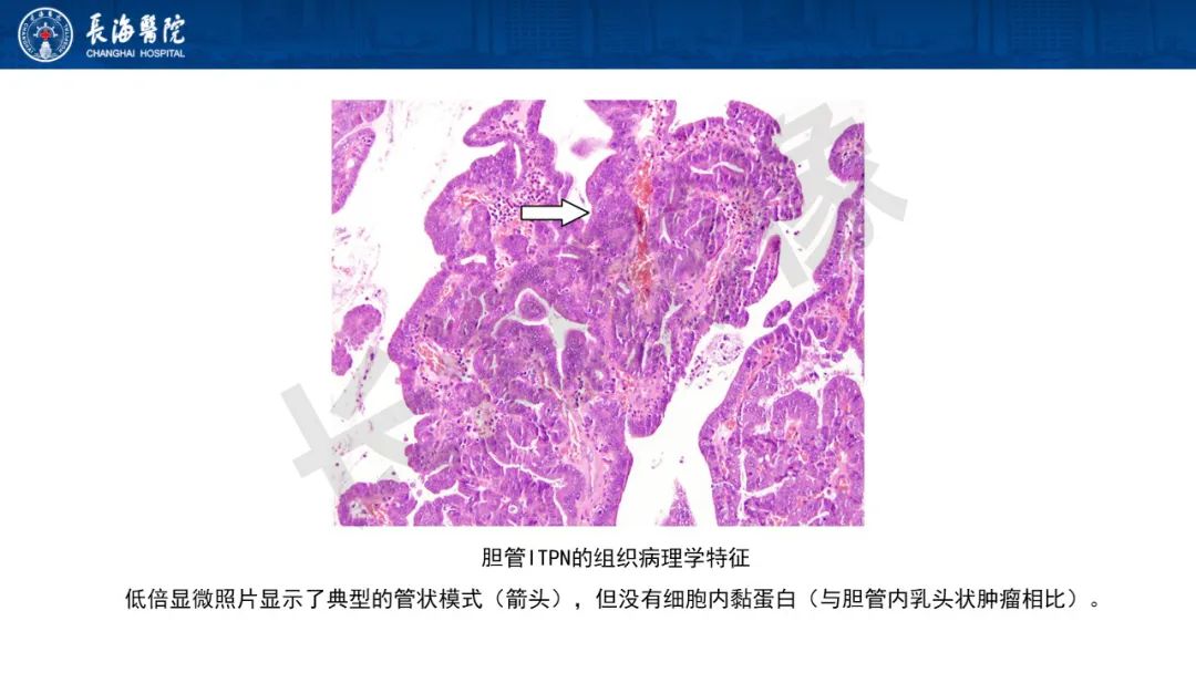 影像PPT - 【PPT】罕见胆道腔内肿瘤的影像学表现-29