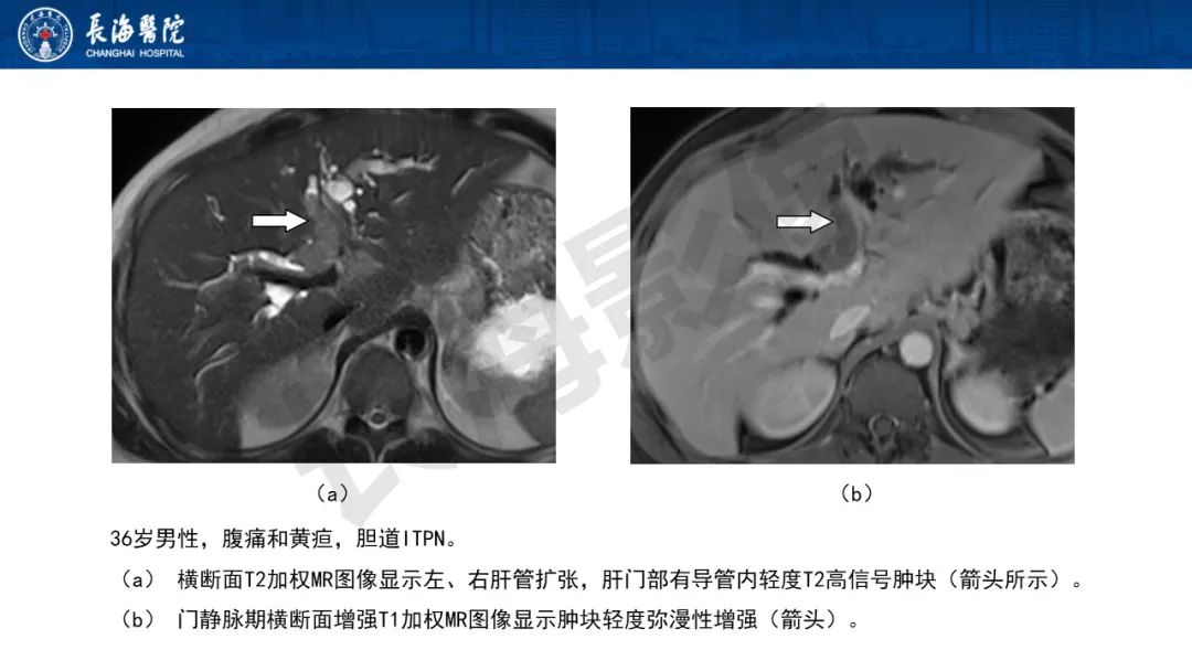 影像PPT - 【PPT】罕见胆道腔内肿瘤的影像学表现-30