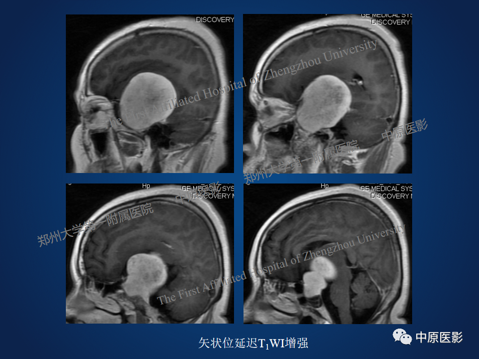 影像PPT - 【病例】鞍旁海绵状血管瘤1例MR-7