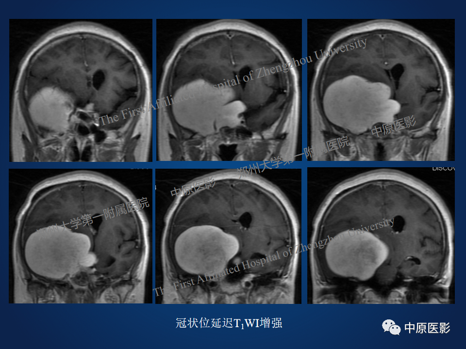 影像PPT - 【病例】鞍旁海绵状血管瘤1例MR-6