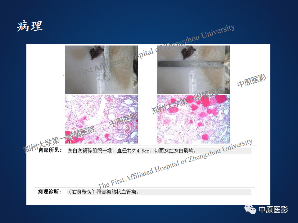 影像PPT - 【病例】鞍旁海绵状血管瘤1例MR-9