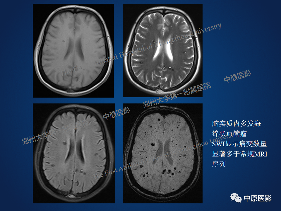 影像PPT - 【病例】鞍旁海绵状血管瘤1例MR-13