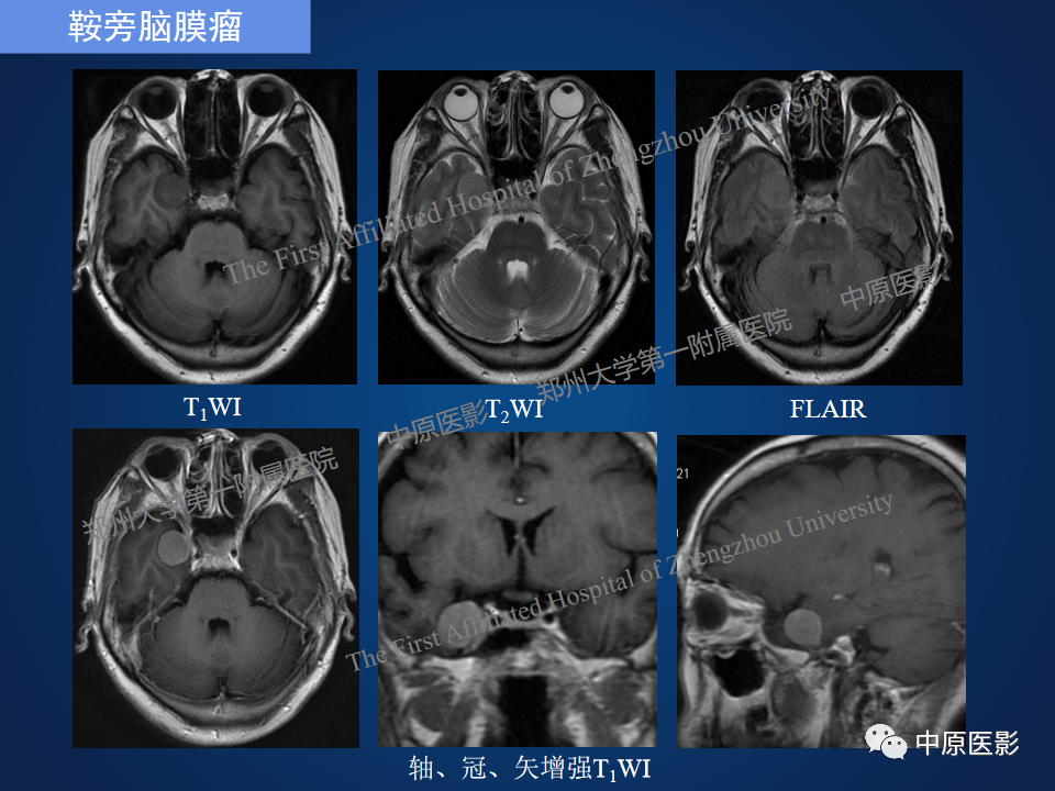 影像PPT - 【病例】鞍旁海绵状血管瘤1例MR-19