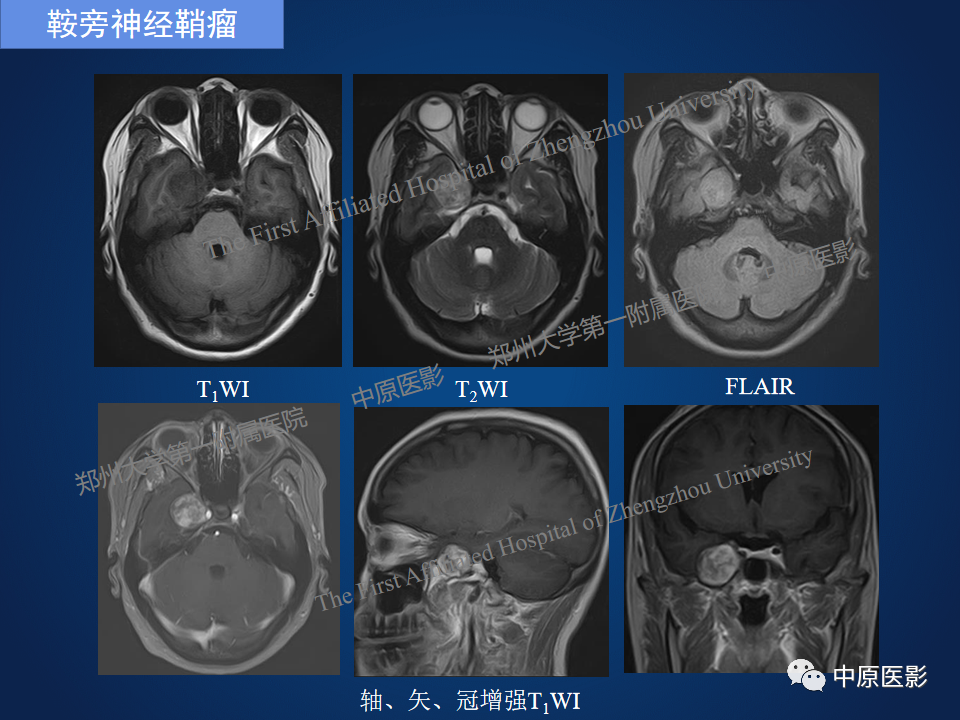 影像PPT - 【病例】鞍旁海绵状血管瘤1例MR-21