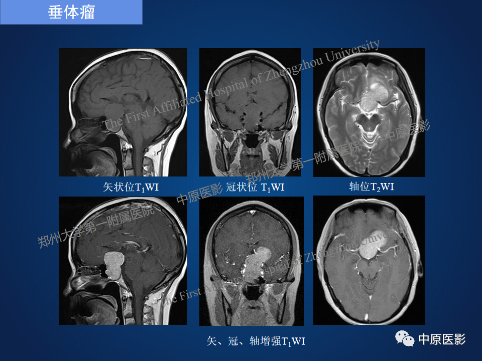影像PPT - 【病例】鞍旁海绵状血管瘤1例MR-23