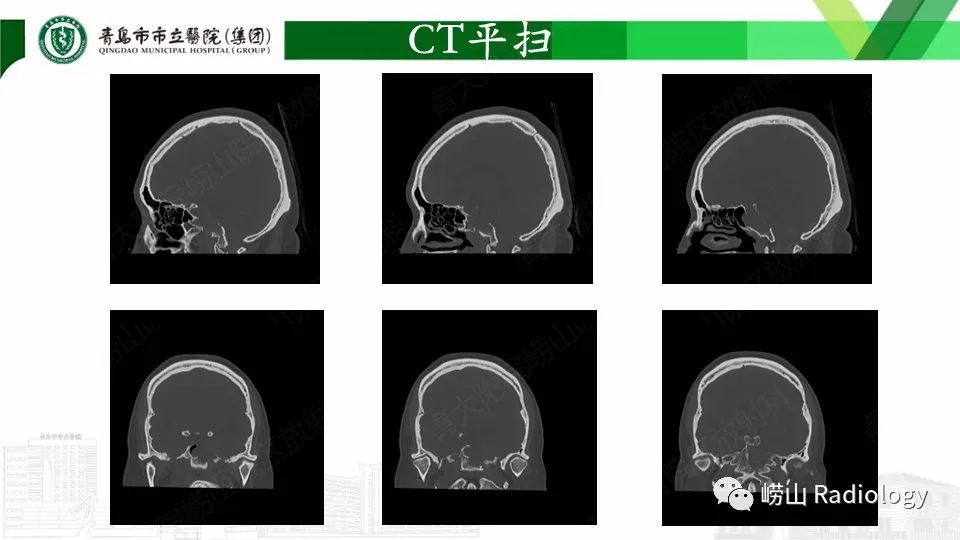 影像PPT - 【PPT】斜坡骨巨细胞瘤-5