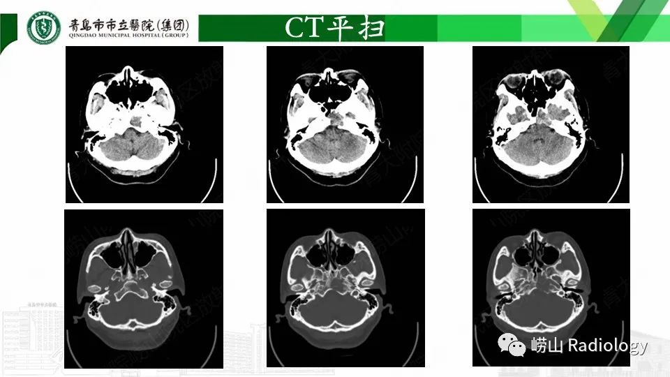 影像PPT - 【PPT】斜坡骨巨细胞瘤-4