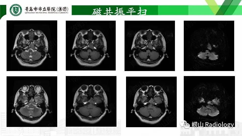 影像PPT - 【PPT】斜坡骨巨细胞瘤-6