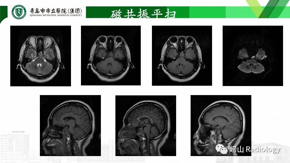 影像PPT - 【PPT】斜坡骨巨细胞瘤-7