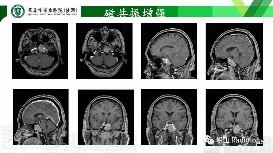 影像PPT - 【PPT】斜坡骨巨细胞瘤-8