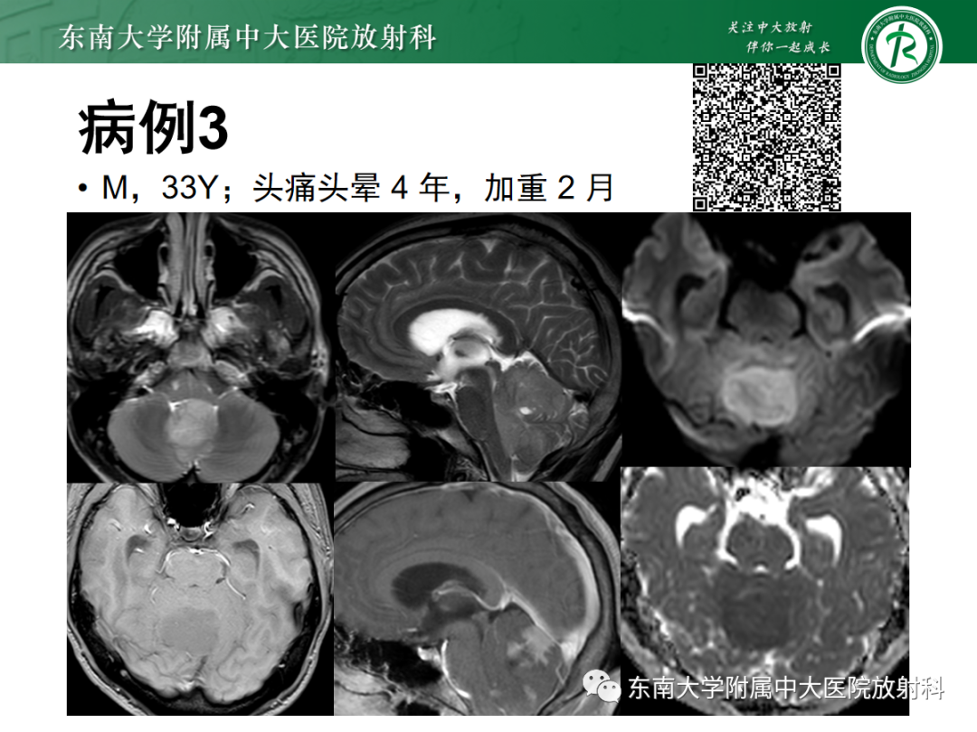 影像PPT - 【PPT】小脑常见占位诊断思路-3