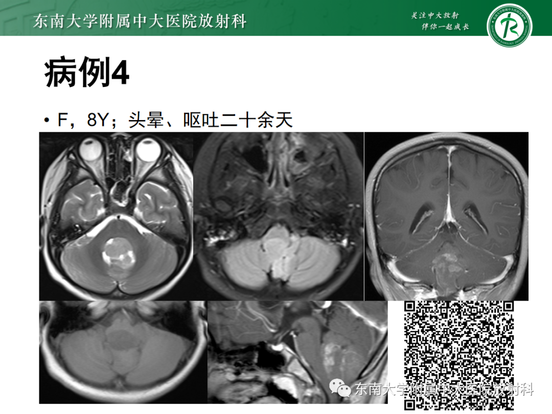 影像PPT - 【PPT】小脑常见占位诊断思路-4