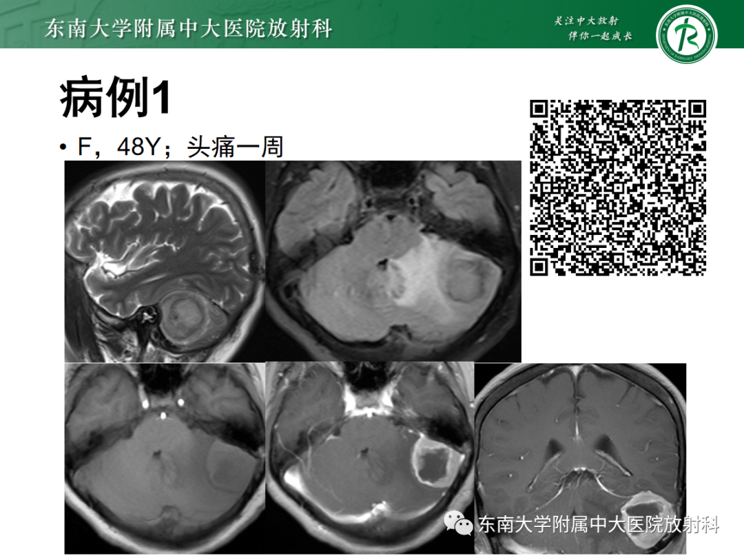 影像PPT - 【PPT】小脑常见占位诊断思路-1