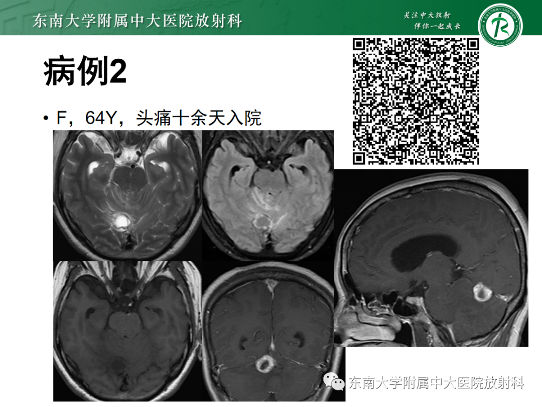 影像PPT - 【PPT】小脑常见占位诊断思路-2