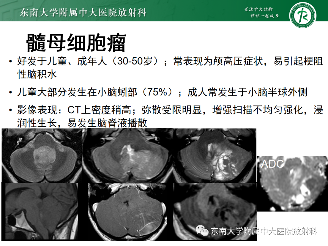影像PPT - 【PPT】小脑常见占位诊断思路-19
