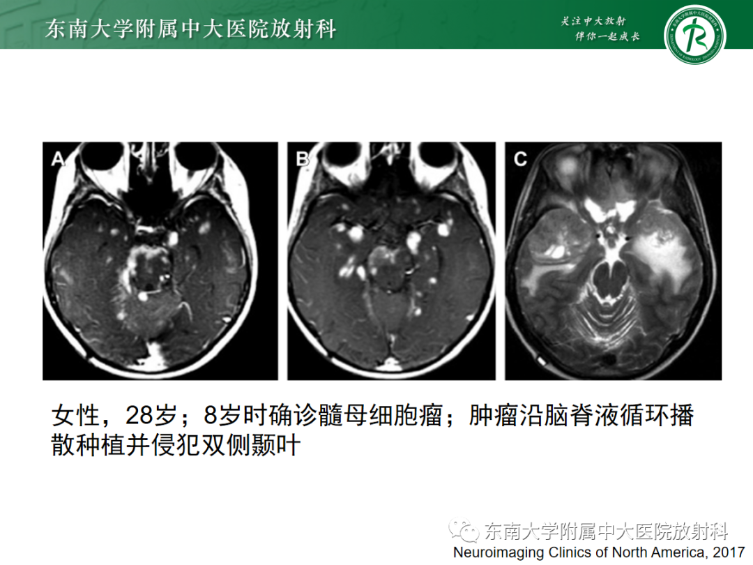 影像PPT - 【PPT】小脑常见占位诊断思路-20