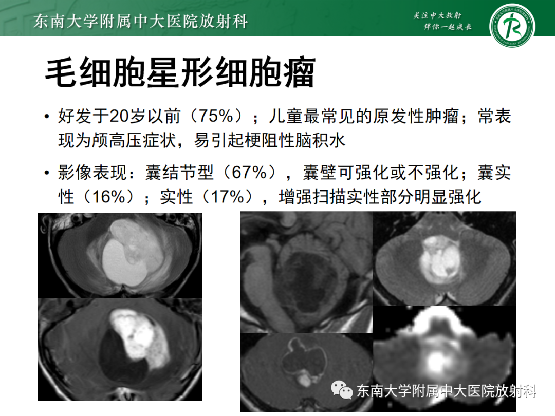 影像PPT - 【PPT】小脑常见占位诊断思路-24