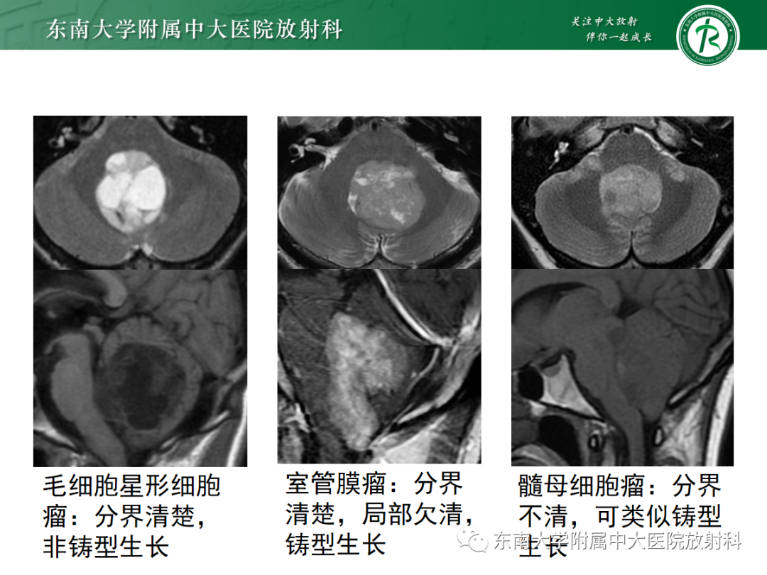 影像PPT - 【PPT】小脑常见占位诊断思路-26