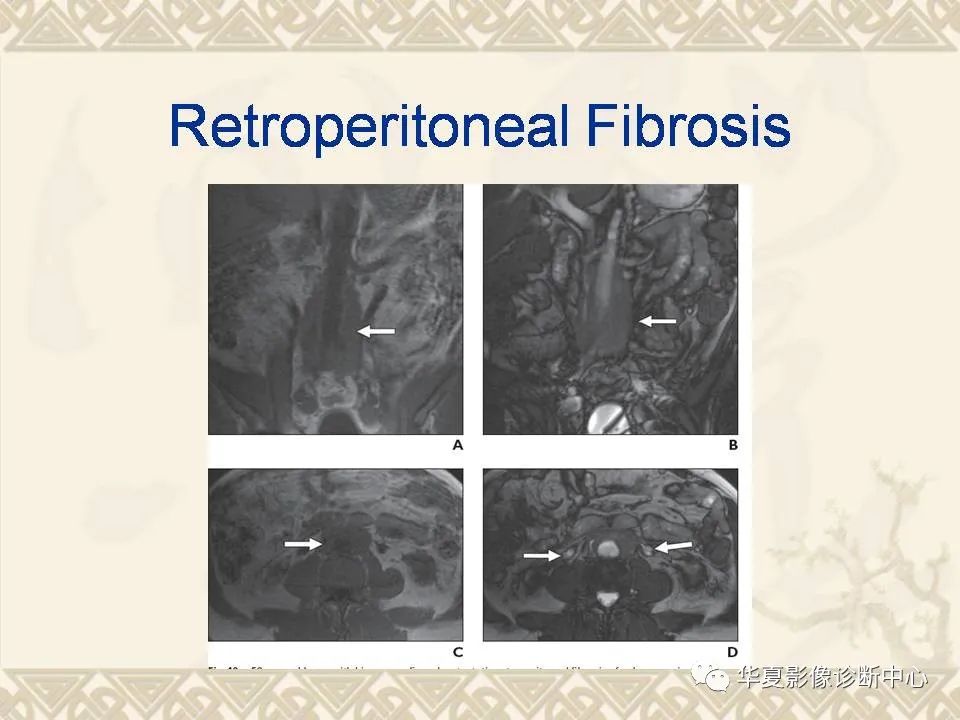 影像PPT - 【PPT】腹膜后纤维化影像诊断-8