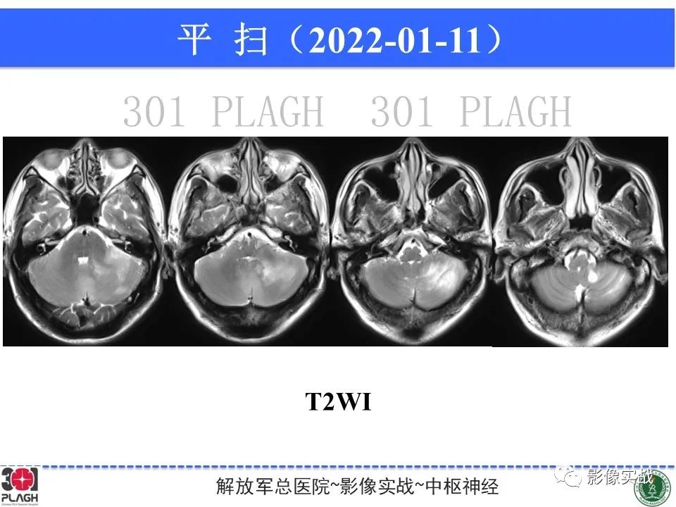 影像PPT - 【PPT】具有毛细胞样特征的高级别星形细胞瘤1例MR-5