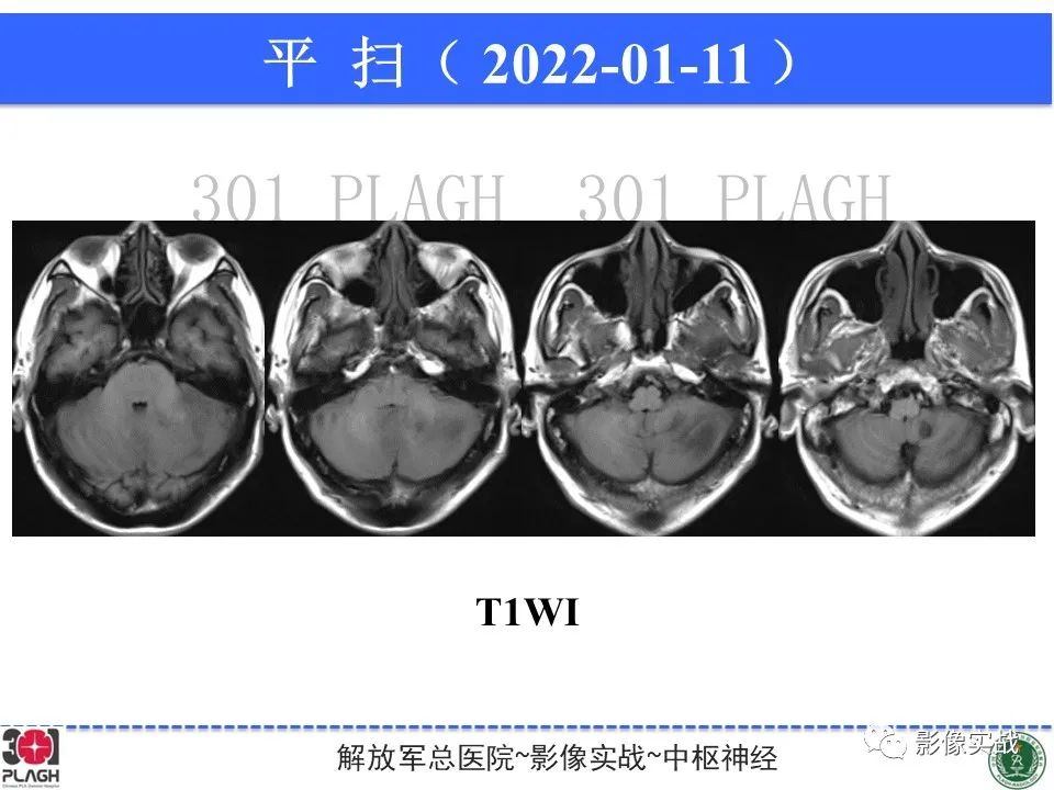 影像PPT - 【PPT】具有毛细胞样特征的高级别星形细胞瘤1例MR-6