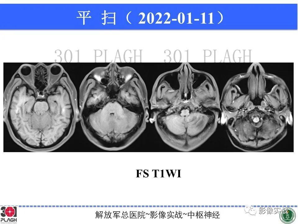 影像PPT - 【PPT】具有毛细胞样特征的高级别星形细胞瘤1例MR-7