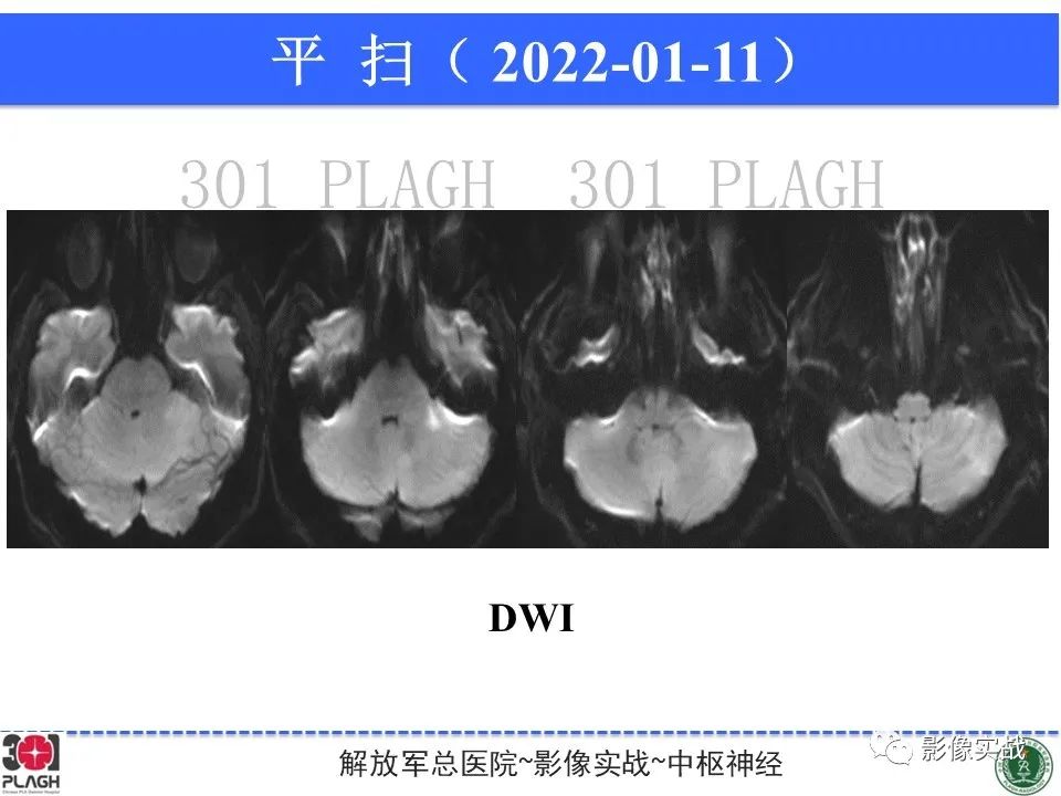 影像PPT - 【PPT】具有毛细胞样特征的高级别星形细胞瘤1例MR-8