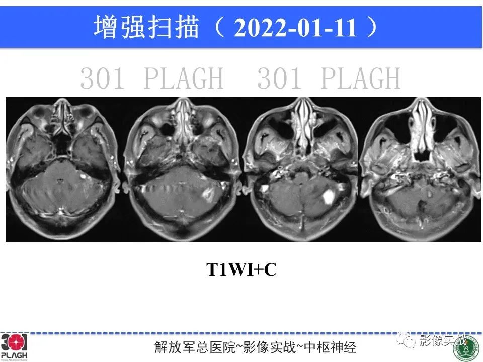 影像PPT - 【PPT】具有毛细胞样特征的高级别星形细胞瘤1例MR-11