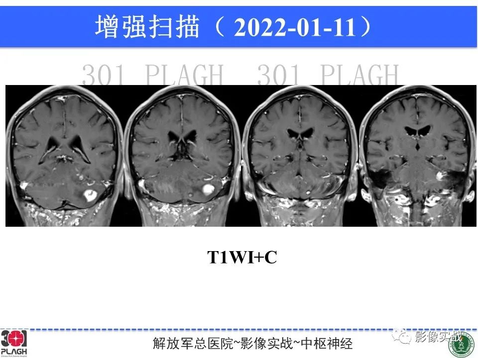 影像PPT - 【PPT】具有毛细胞样特征的高级别星形细胞瘤1例MR-12